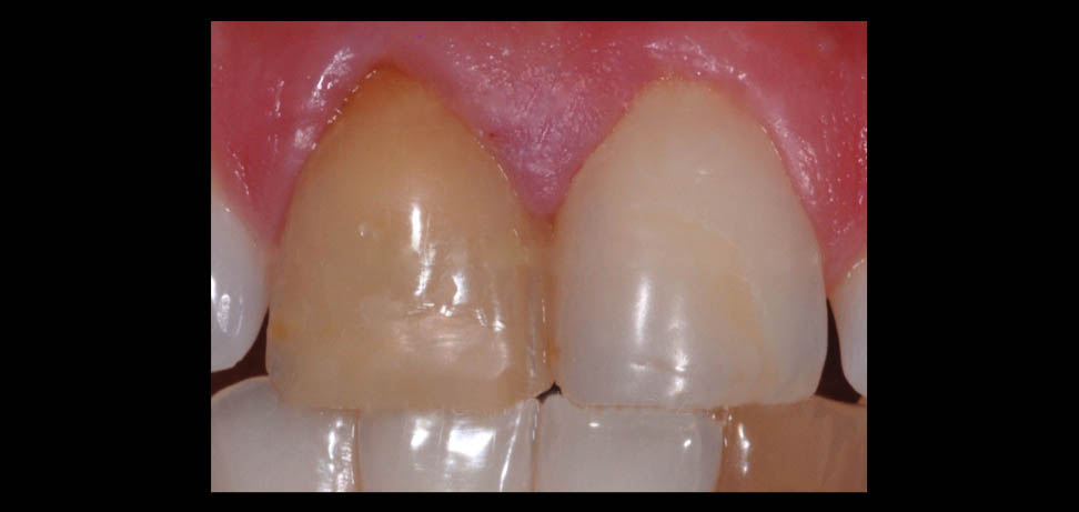 سفید کردن دندانهای عصب کشی شده در مطب