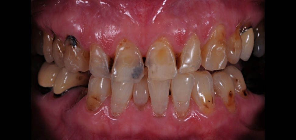 درمانهای پروتز بر روی دندانهای طبیعی