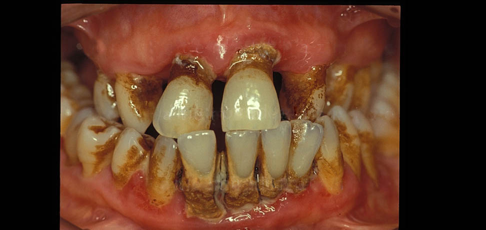 پوسیدگی دندان و بیماری های مرتبط با لثه