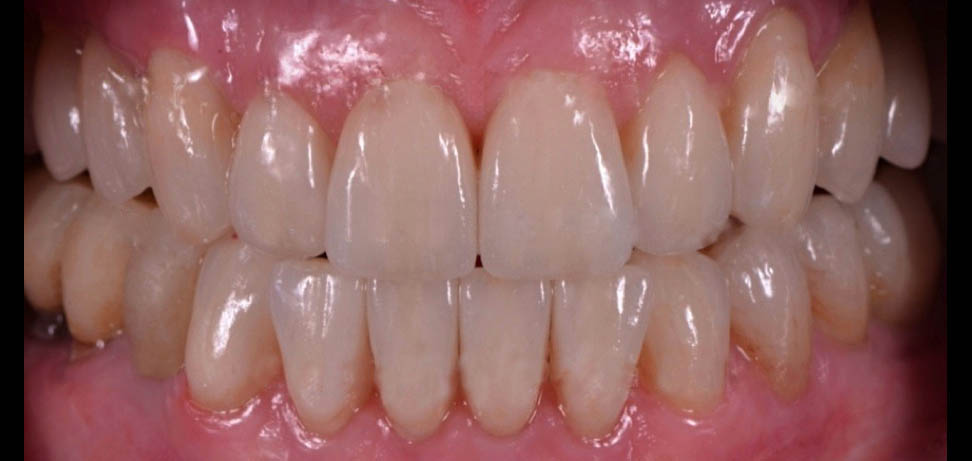 درمانهای پروتز بر روی دندانهای طبیعی