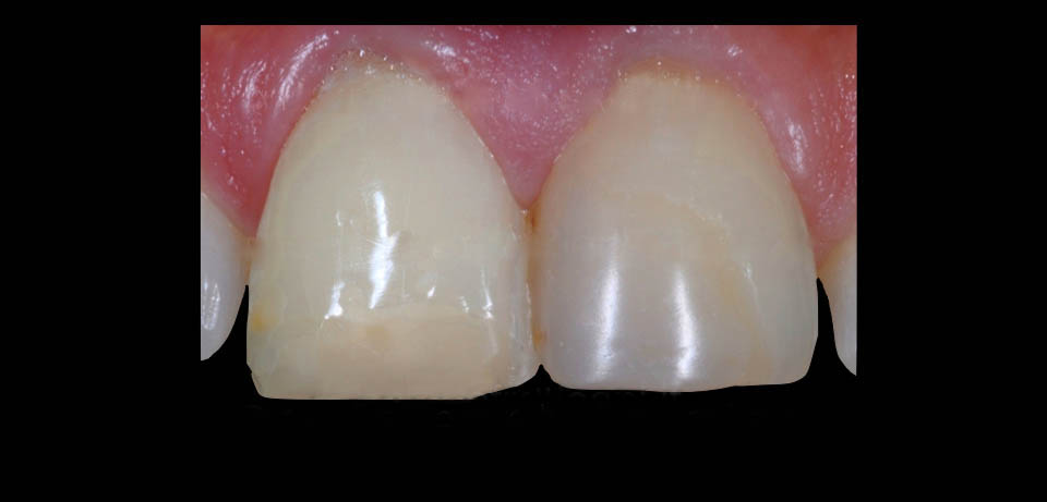 سفید کردن دندانهای عصب کشی شده در مطب